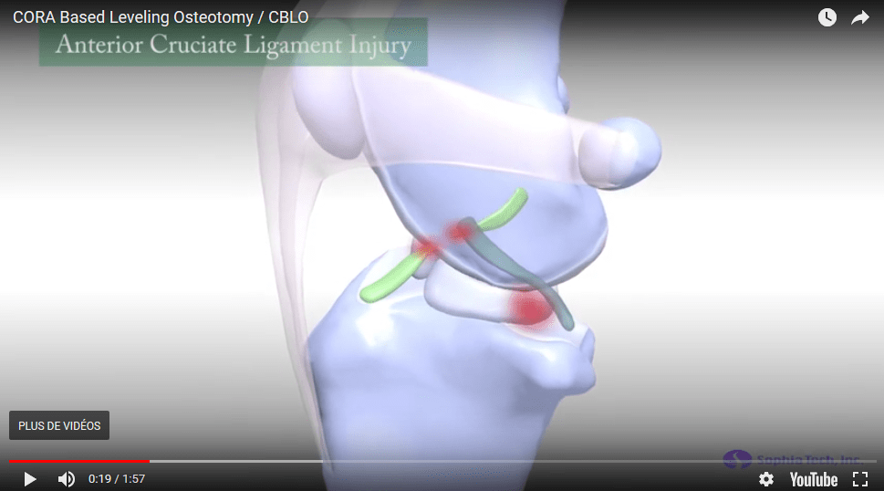CORA Based Leveling Osteotomy / CBLO, traitement chirurgical de la rupture du LCA (youtube)