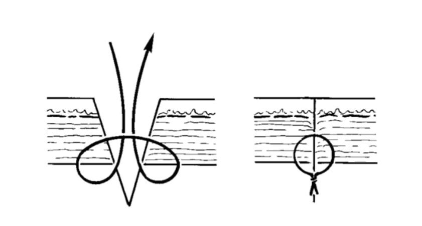 La suture cutanée (humaine)